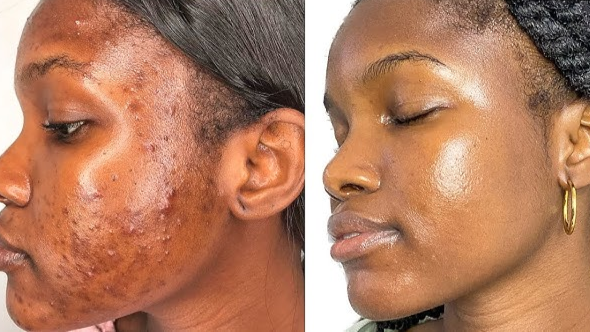 Acne & Hormonal Breakout + Acne & Oil Control Programs
