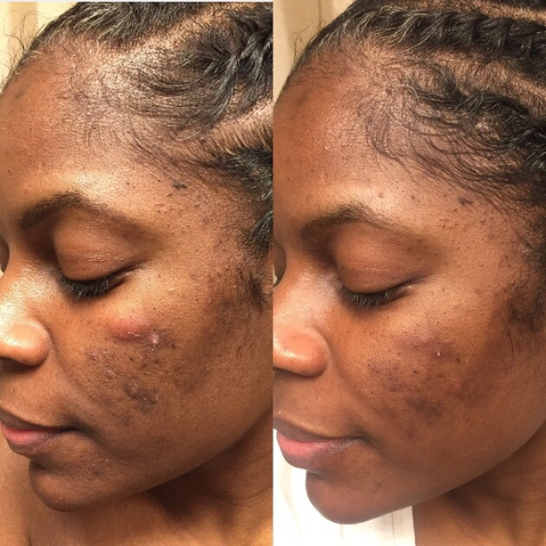 Acne & Hormonal Breakout + Acne & Oil Control Programs