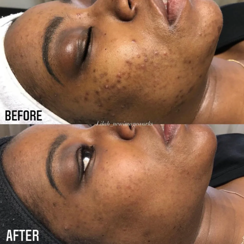 Microneedling & PRP for Skin Rejuvenation — Accra