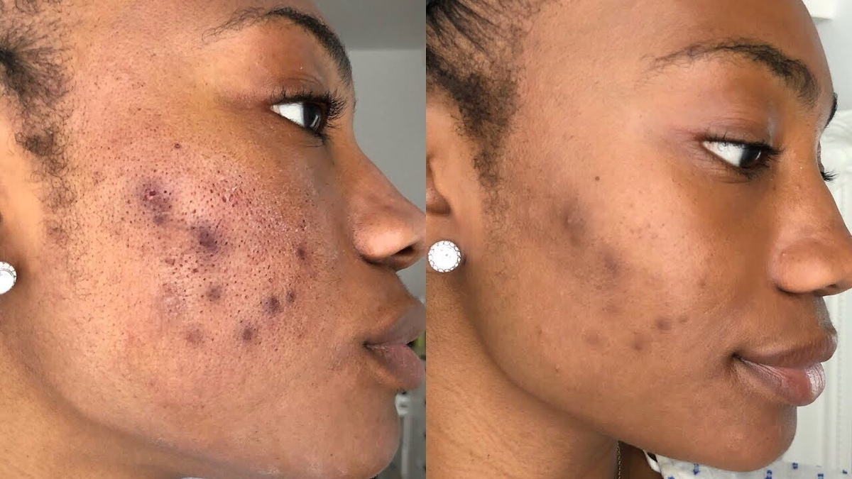 Microneedling & PRP for Skin Rejuvenation — Accra