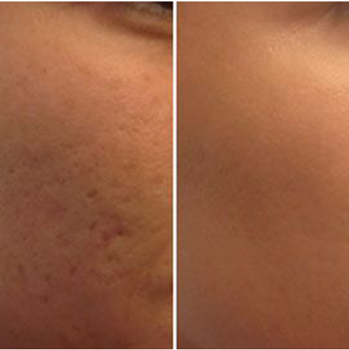 Microneedling & PRP for Skin Rejuvenation — Accra
