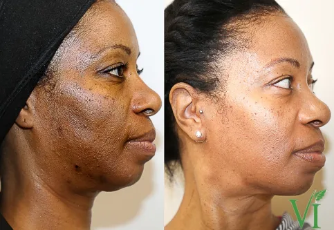 Hyperpigmentation & Melasma Management