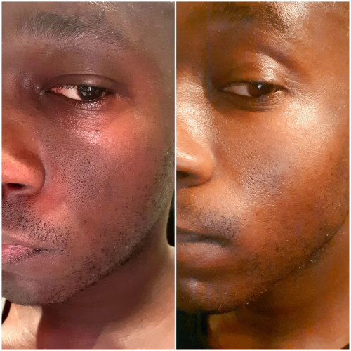 Hyperpigmentation & Melasma Management