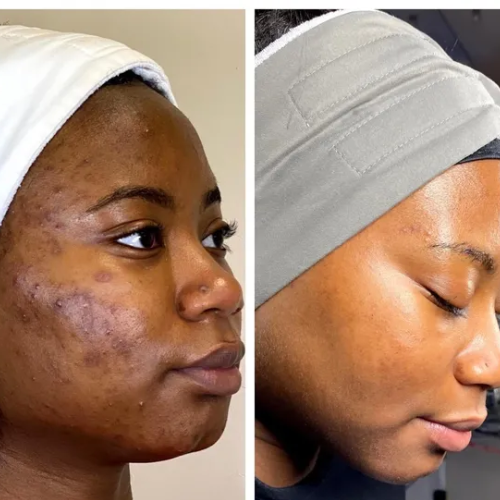 Acne & Hormonal Breakout + Acne & Oil Control Programs