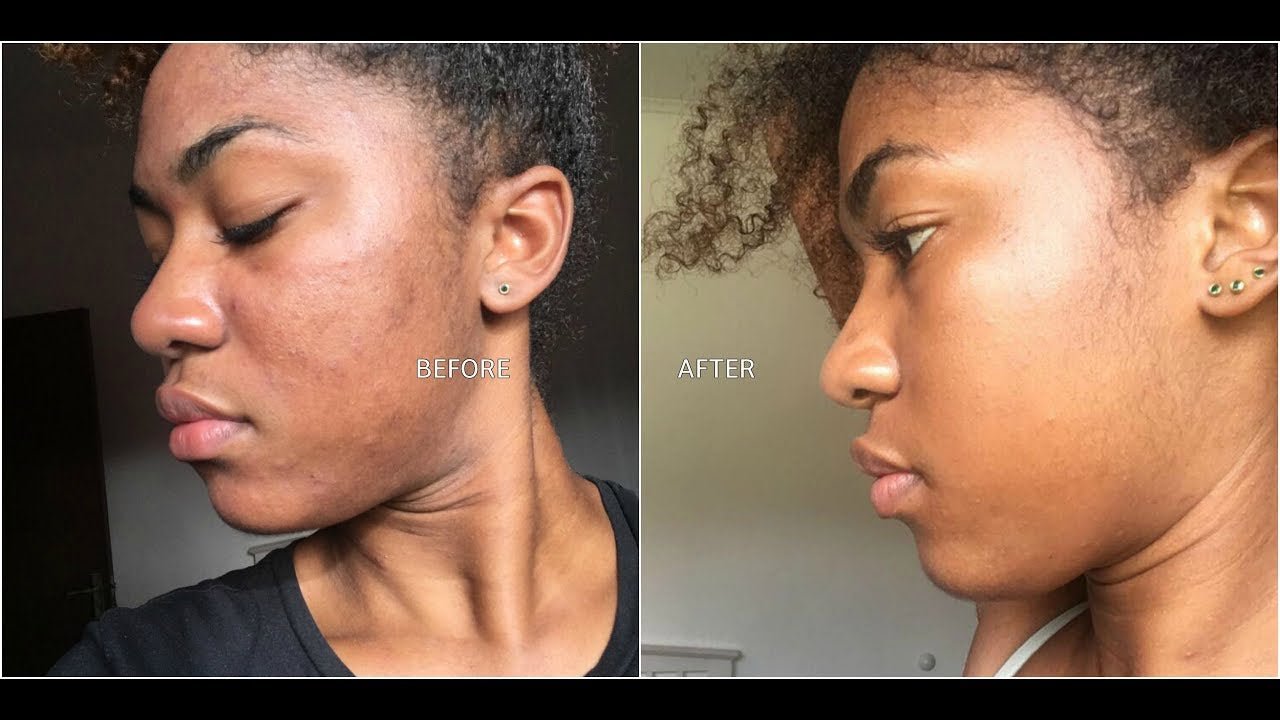 Microdermabrasion Facial - Seraphim Beauty