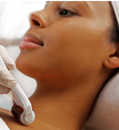 Microneedling - Seraphim Beauty