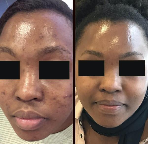 Microneedling - Seraphim Beauty