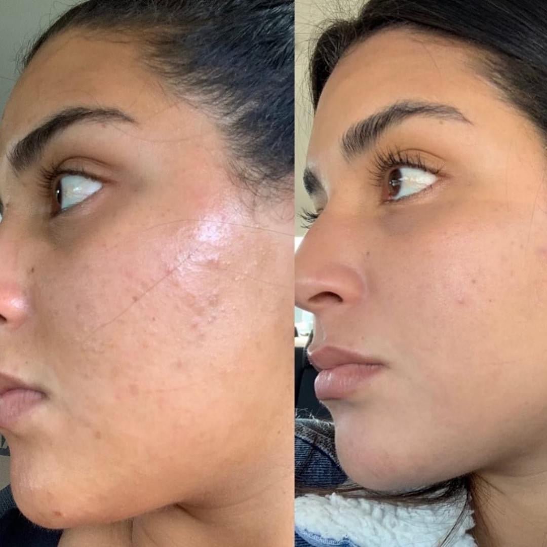 glutathione peel The Perfect Derma Pro Clinical Peel | Light Chemical Peel | Acne & Oily  Skin Treatment
