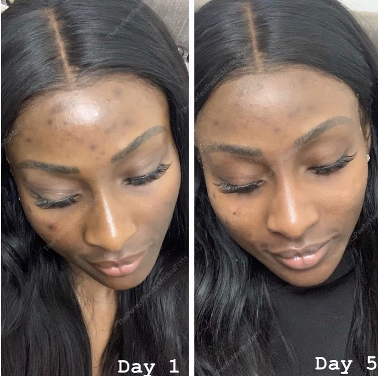The Perfect Derma Peel | Medium Depth Chemical Peel | Dark Spot & Acne Treatment | Accra