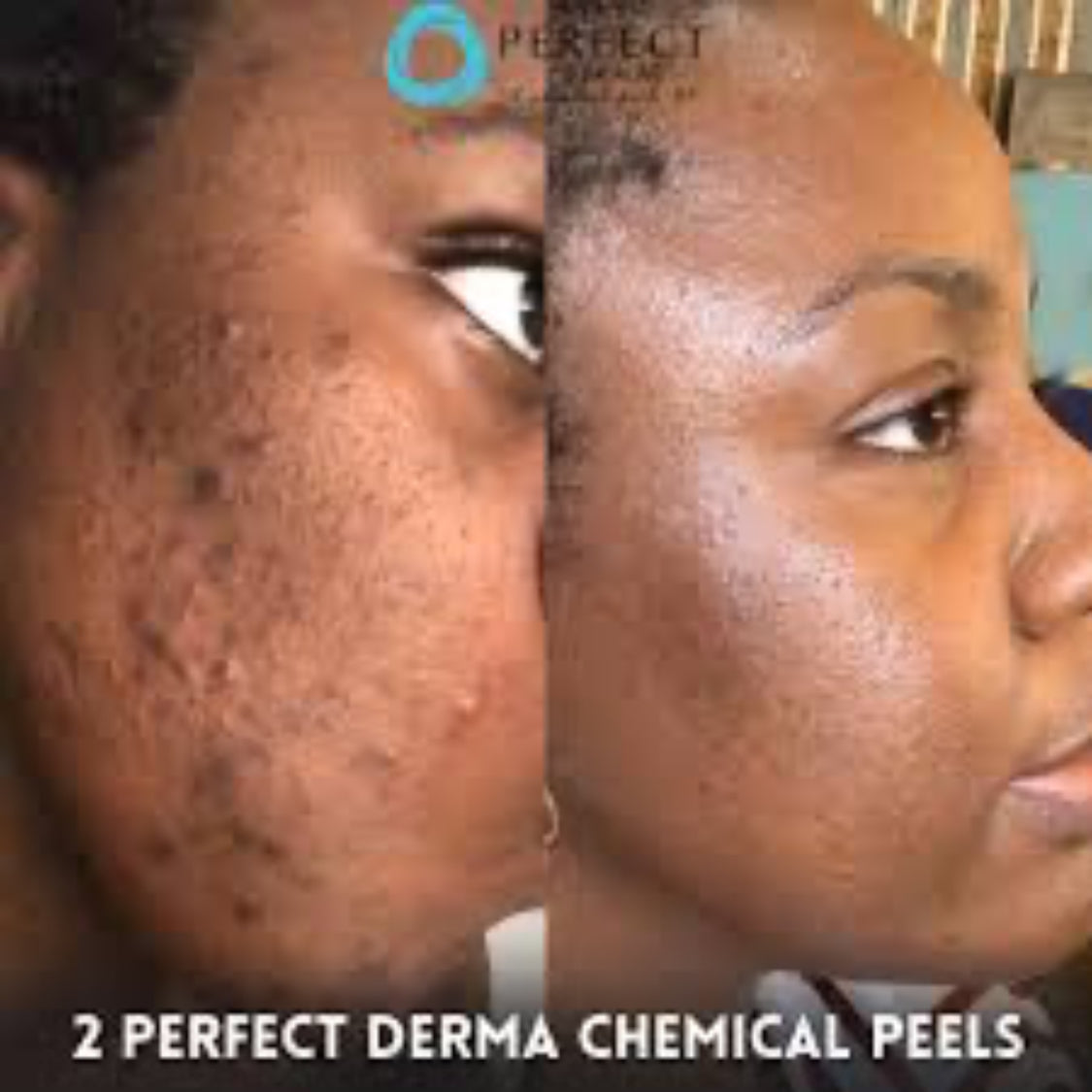 The Perfect Derma Peel | Medium Depth Chemical Peel | Dark Spot & Acne Treatment | Accra