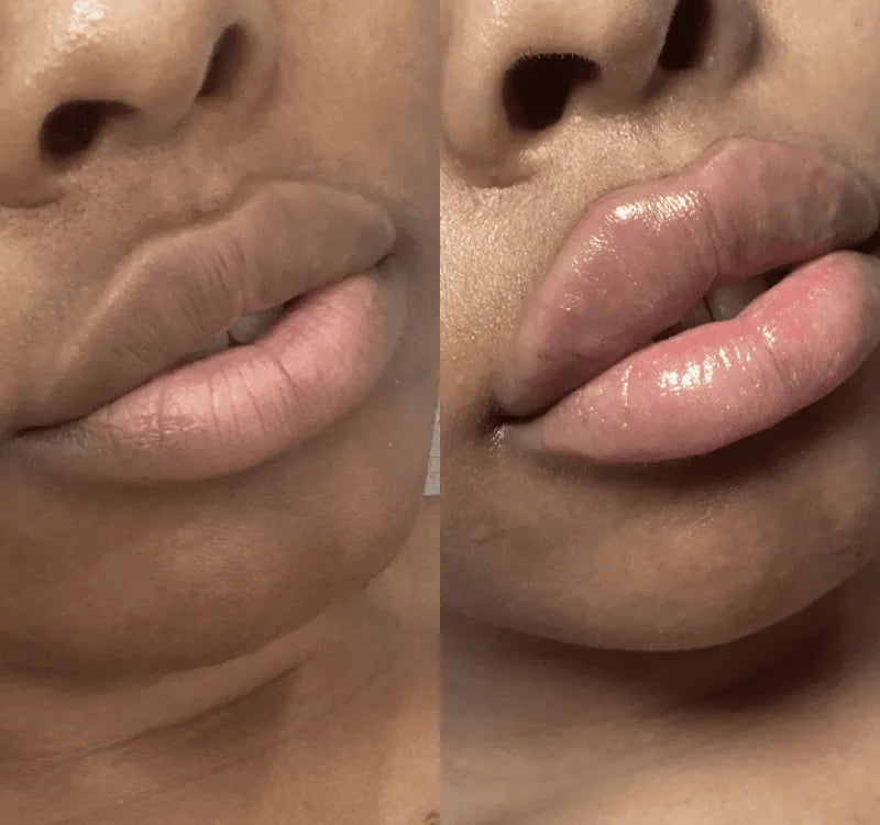 Dermal Filler Treatment