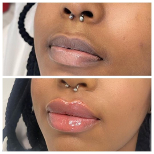 Dermal Filler Treatment