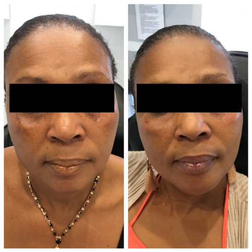 Microneedling results